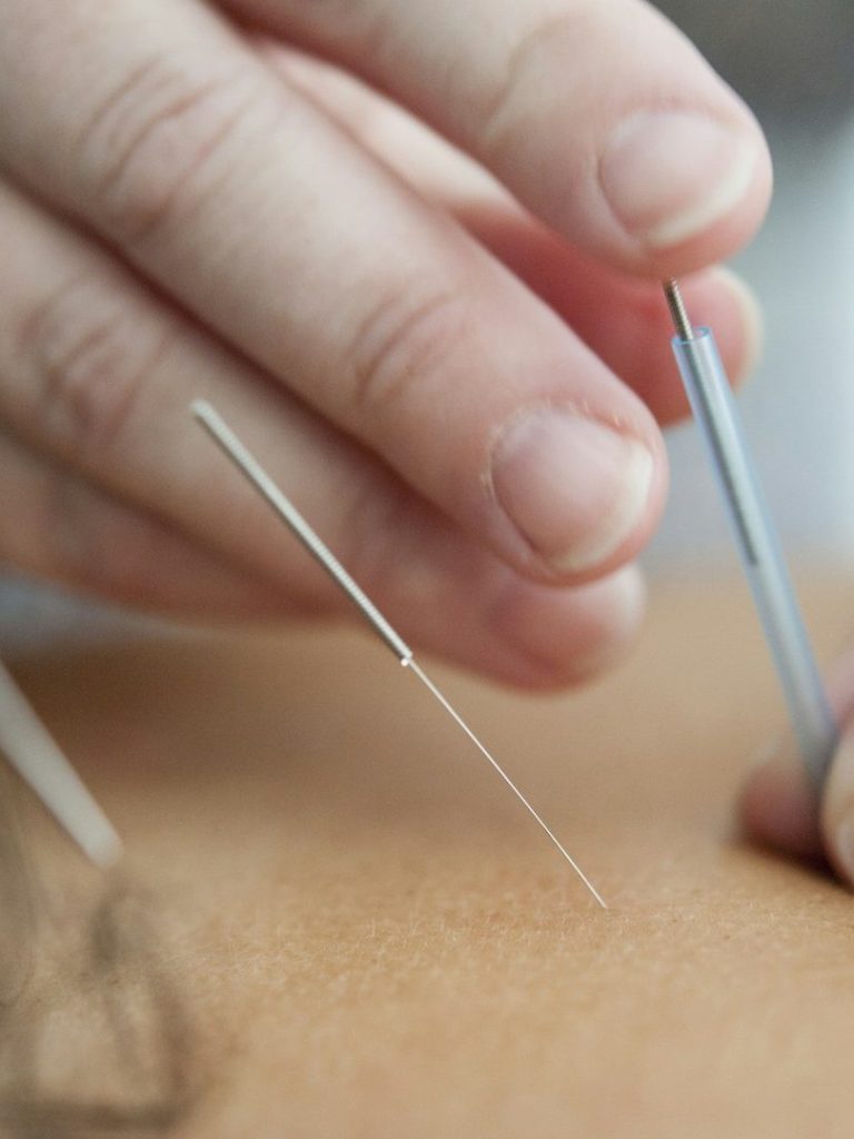 A hand inserting an acupuncture needle into a person's skin.