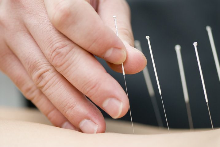 A hand placing acupuncture needles on a person's skin.